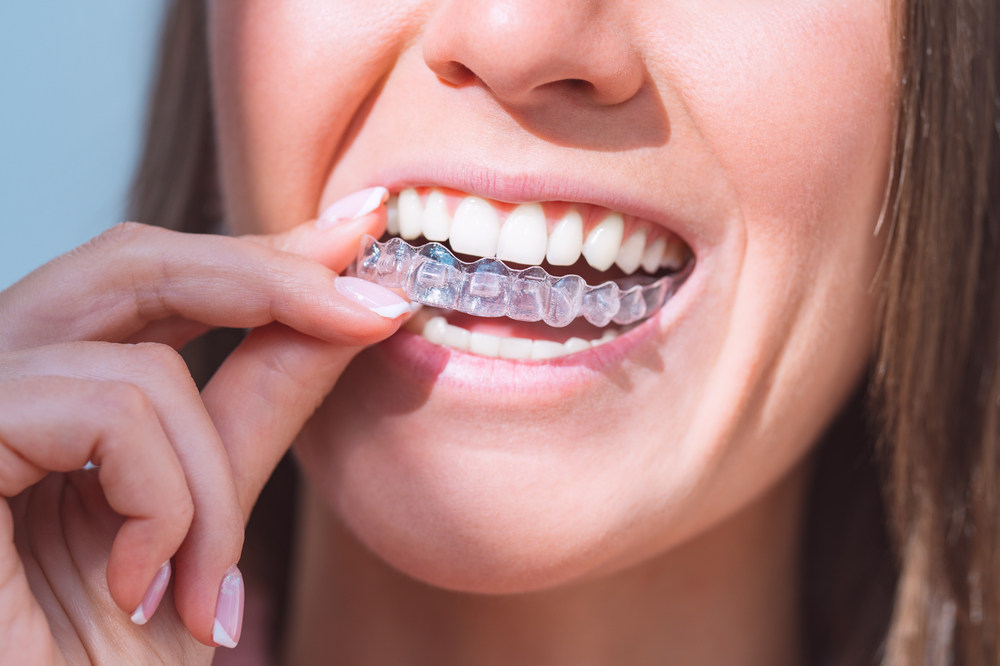 10 Unique Benefits of Invisalign at Wright Orthodontics in Batavia, CA